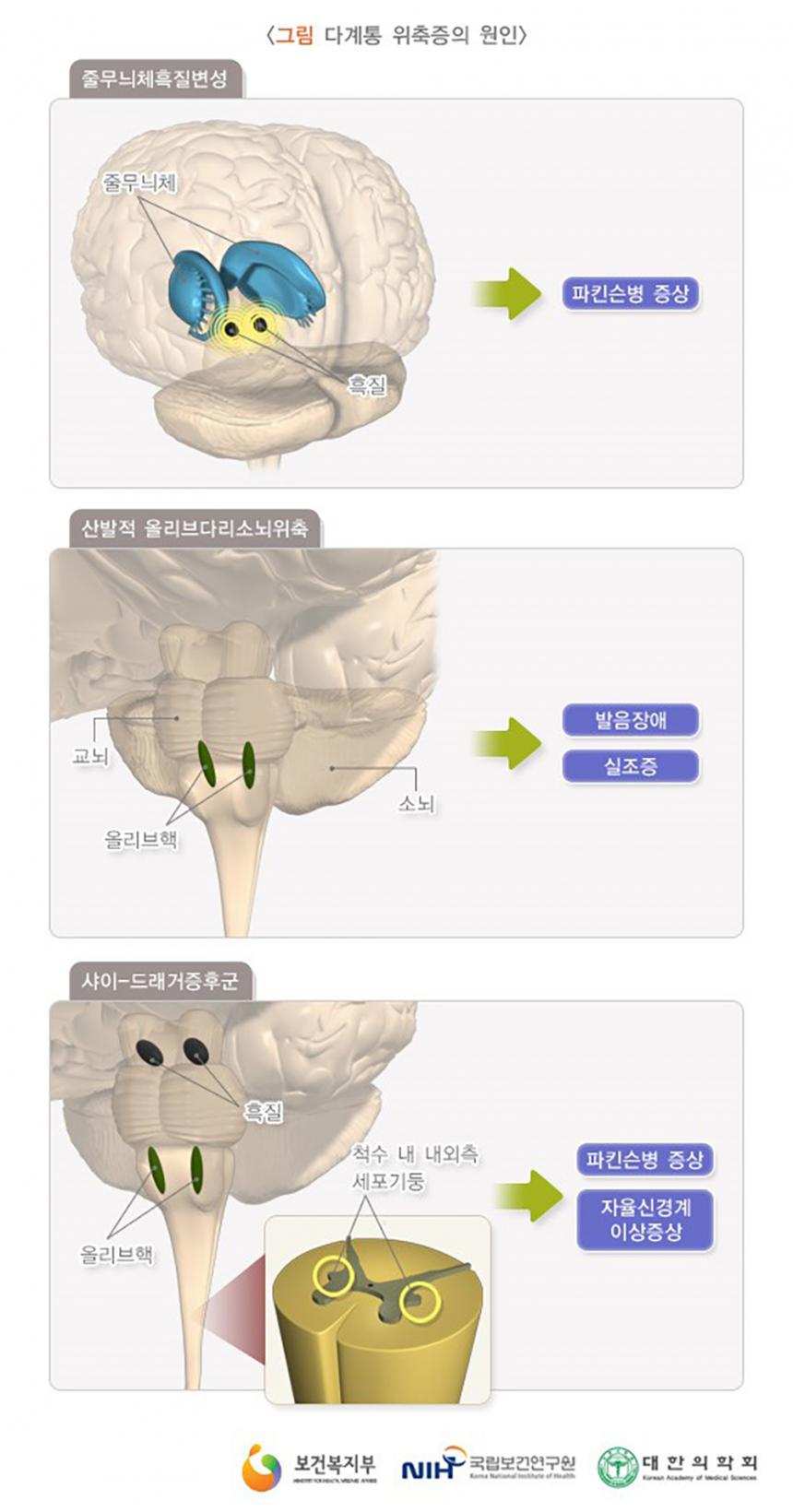 다계통 위축증 / 보건복지부, 국립보건연구원, 대한의학회