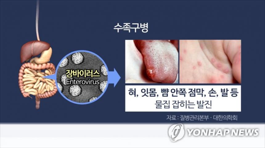 수족구병(CG) / 연합뉴스TV 제공