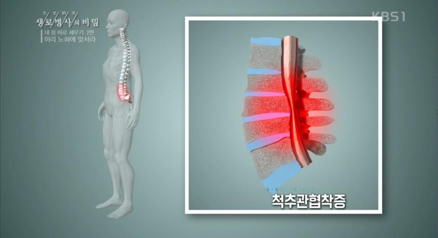 KBS1 ‘생로병사의 비밀’ 방송 캡처