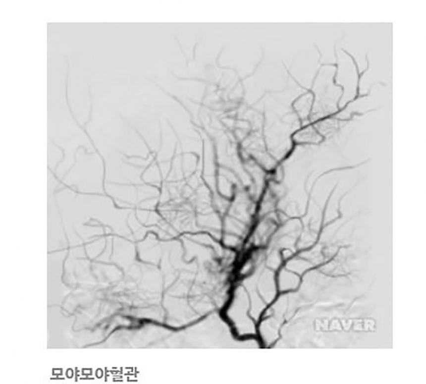 ‘모야모야’ 혈관/네이버