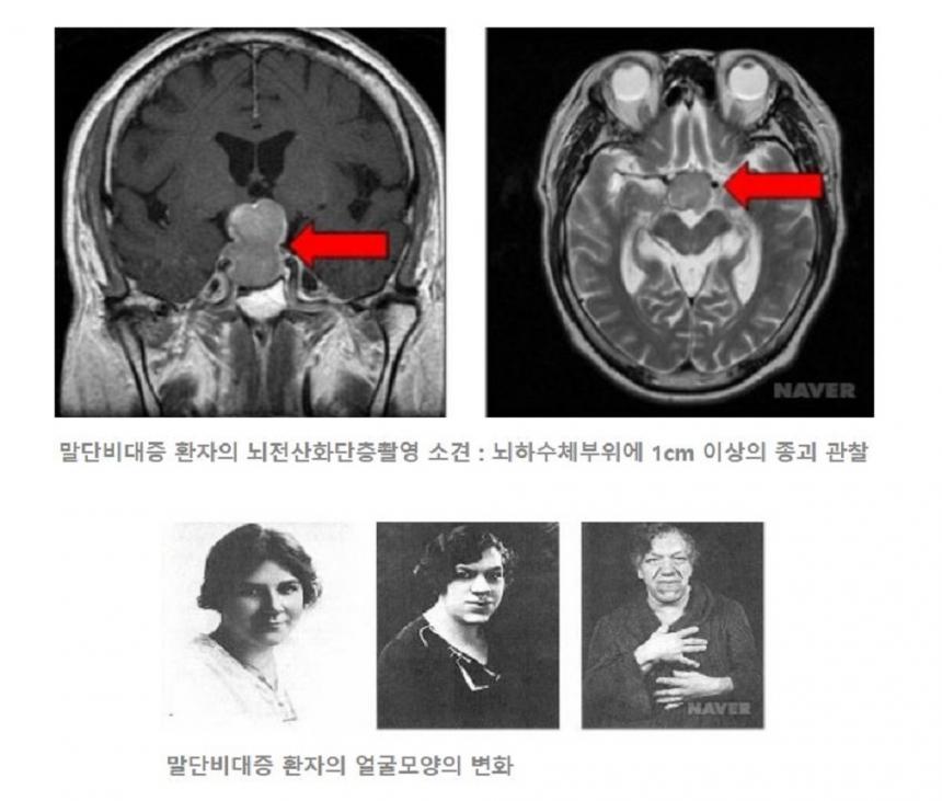 세브란스 건강 칼럼 / 네이버 지식백과 제공