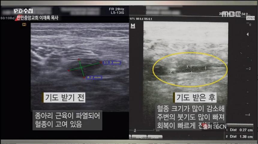 MBC ‘PD수첩’ 방송 캡처