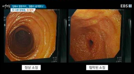 크론병 증상 /