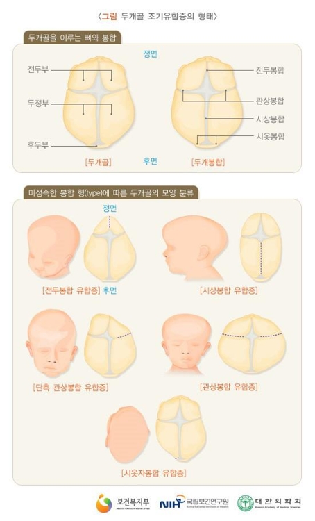 두개골 조기유합증의 여러 형태 / 국가건강정보포털, 연합뉴스 제공