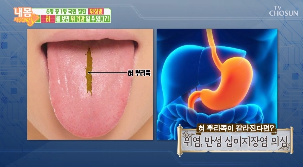 혀 / TV조선 ‘내 몸 사용 설명서’ 방송캡처