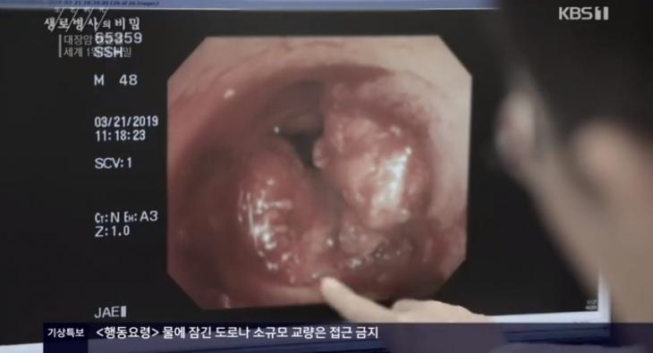 대장암 / KBS1 '생로병사의 비밀' 캡처