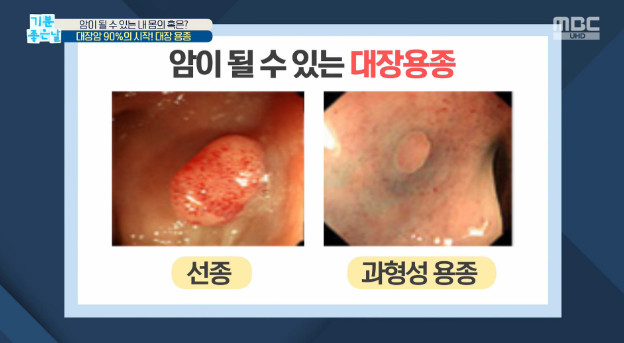 MBC ‘기분좋은날’ 방송 캡처