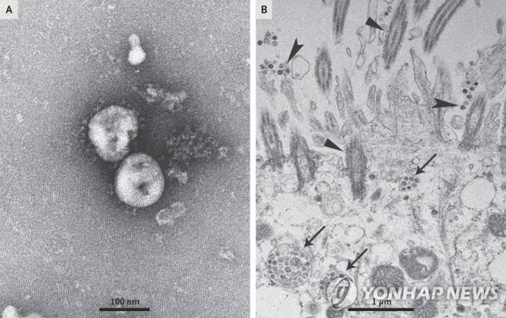 배양된 신종 코로나바이러스를 광학현미경으로 관찰한 모습 / [NEJM 논문 발췌]