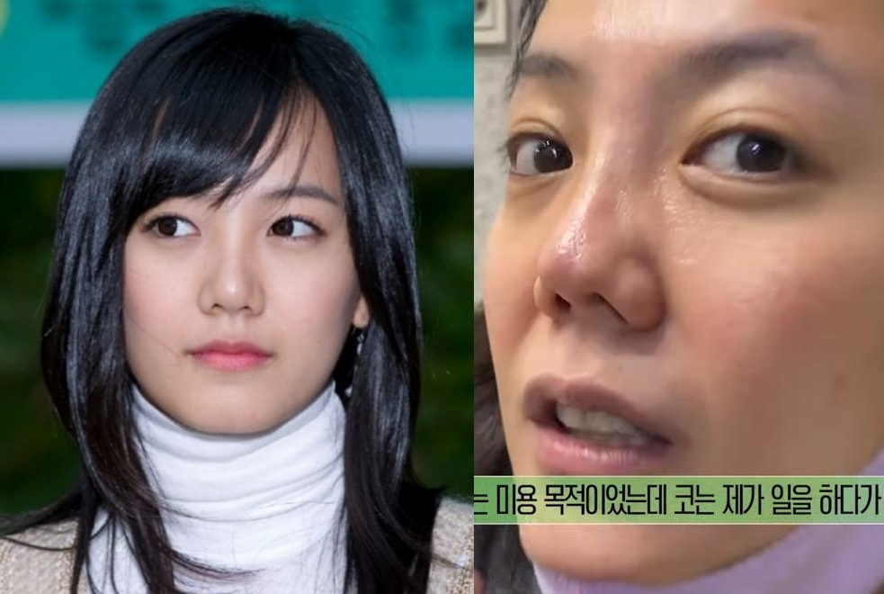고은아, 심각한 코 상태 공개…성형 전후→모발이식 후 근황 - 한수지 기자 - 톱스타뉴스