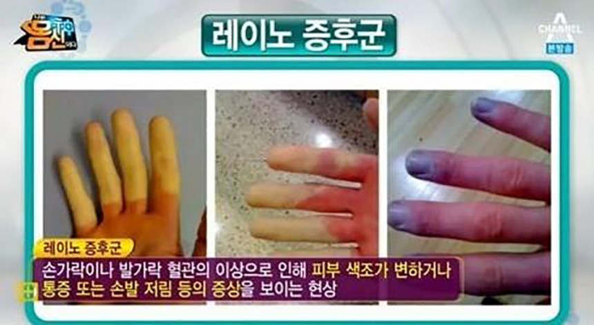 레이노 증후군 관련 방송 캡쳐 / 채널A