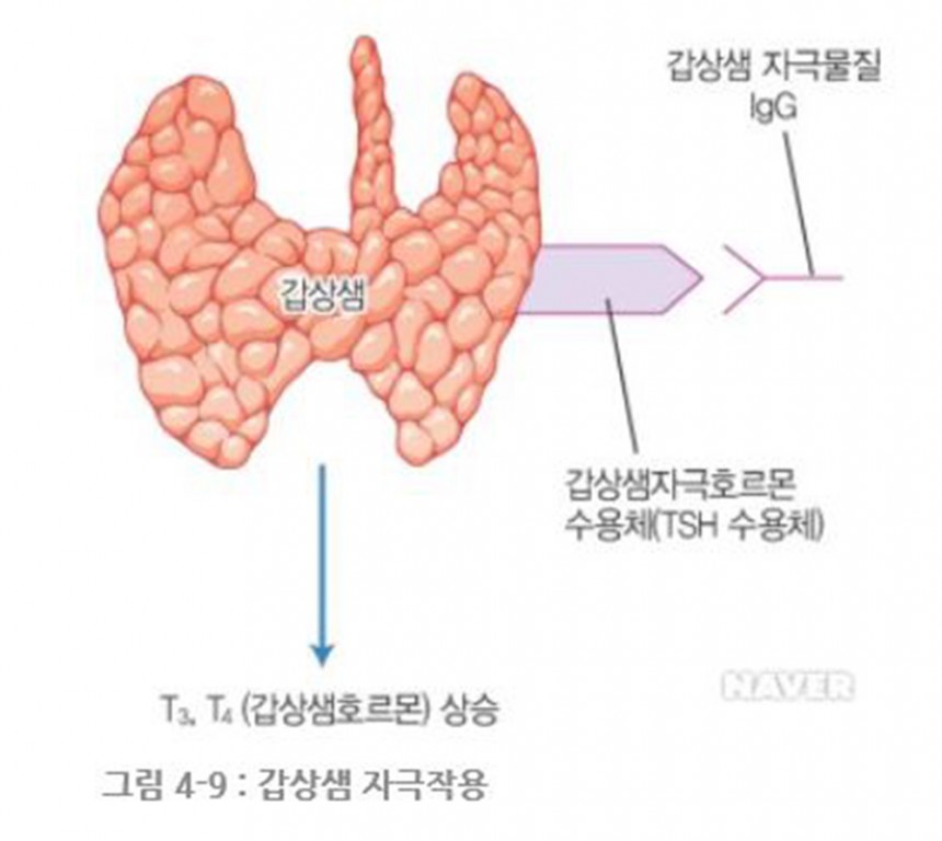 그레이브스 병 네이버 이미지