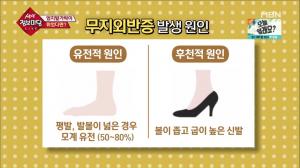 ‘생생 정보마당’ 엄지발가락이 휘었다? ‘무지외반증’의 원인은?