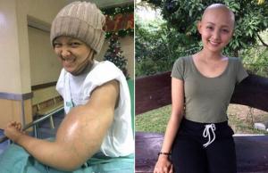 암과의 사투 끝에 한쪽 팔을 절단 했지만 미소 잃지 않는 여성…‘긍정의 힘’