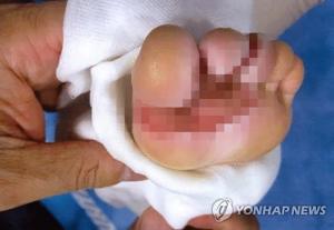 영유아 화상 사고…가정 내 사고 절반 이상이 주방에서 발생