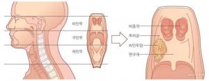 비인두암, 비인두에 생긴 악성 종양을 의미…’원인과 증상은?’