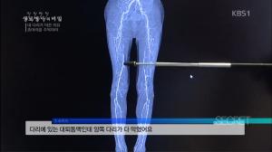 ‘생로병사의 비밀’ 다리에도 동맥경화가? 종아리에서 보내는 신호를 파악해야