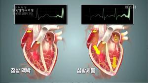 ‘생로병사의 비밀’ 나이든 심장으로 발생하는 심방세동이란 무엇인가? 뇌졸중과의 연관성까지 파악해보자