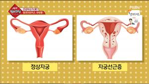 ‘생생정보마당’ 월경통 심하면 의심되는 자궁선근증, 치료 방법은?