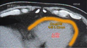 ‘생로병사의 비밀’ 이소성지방이 우리에게 미치는 영향은?