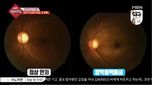 ‘생생정보마당’ 눈 중풍(망막혈관폐쇄증) 원인과 예방법은?