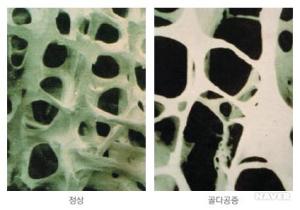 골다공증, 원인과 증상은?…골다공증에 좋은 음식 눈길