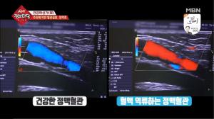 ‘생생정보마당’ 하지정맥류 수술 통증 없이 가능하다고? 방치하지 말고 조기진단하자