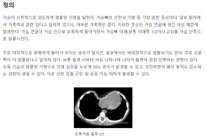 오목가슴, 선천적으로 함몰된 기형 가슴…‘관련 질병은?’