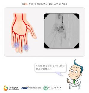 한랭·심리적 변화로 인해 손가락 색이 변하는 ‘레이노 증후군’…치료 방법은?