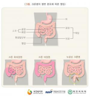 소화관 전체에 발생하는 만성 염증성 질환 ‘크론병’…주로 일어나는 증상은?