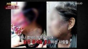 ‘제보자들’ 헤나 염색 부작용 피해자, 검게 변한 얼굴에 대인기피증까지 ‘분통’