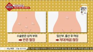 ‘생생정보마당’ 젊은 층에도 발생할 수 있는 탈장, 원인과 예방법은?