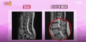 ‘엄지의 제왕’, 허리 디스크 수술 없이 통증 줄이는 방법 전수