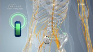 ‘생로병사의 비밀’ 만성통증 조절하는 약물 펌프 주입술이란?