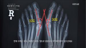 ‘생로병사의 비밀’ 하이힐의 대가 무지외반증, 증상 완화할 수 있는 운동은?
