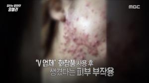 [리부트] ‘당신이 믿었던 페이크 시즌2’, 임블리(임지현) 화장품 피해자 만났다…’심각한 피부 부작용’