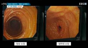 윤종신 병으로 알려진 &apos;크론병&apos; 증상-발병 원인-치료방법은?…"평생 조심해야 되는 병이다"