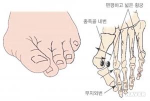 무지외반증이란, 발가락 꺽이며 통증 유발하는 질환…예방법에 쏠리는 시선