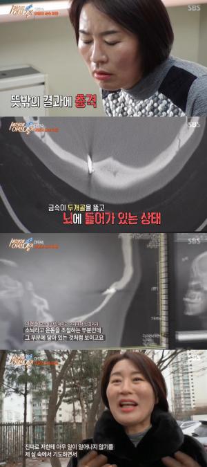 &apos;세상에이런일이&apos; 머릿속 금속 파편 &apos;충격&apos;, 두개골 뚫고 뇌에 닿아 "천운" (2)