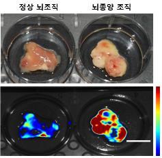 서울대의대·경희대의대, 5분 이내에 신속하고 정확하게 뇌종양 진단한다