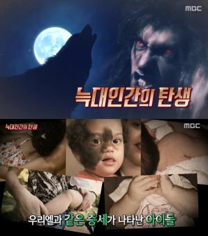 ‘서프라이즈’ 늑대인간, 아이가 태어난지 6개월 만에 온몸이 털로 덮이고 늑대인간 증후군에 걸려…원인은 위-식도 역류 치료제 ‘미녹시딜’ 들어간 위장약?  (1)