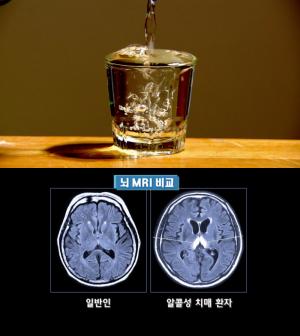 알콜성치매, 의사가 설명하는 증상 보니…"비타민 부족으로 치매 빠져"