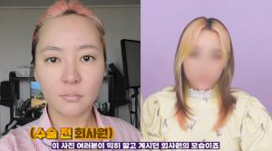 회사원A, 코 수술로 달라진 얼굴 공개…전·후 차이 보아하니?