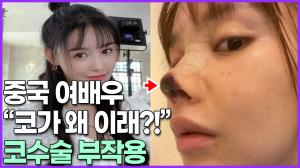 [영상] 중국 여배우 "코가 왜 이래?!" 코 수술 부작용