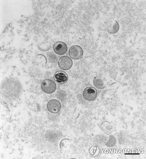 "원숭이두창 조용한 확산은 글로벌 방역체계의 실패"
