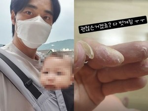 윤주만, 수족구병 후유증…"다 벗겨짐"