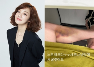 황보라, 다리에 피멍 무슨 일?…"너무 아프다"