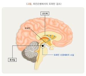 "우울증 환자 노리는 파킨슨병, 운동 지속 땐 위험 &apos;뚝&apos;"