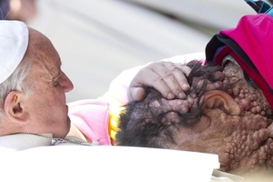 교황에 &apos;축복의 키스&apos; 받았던 신경섬유종 환자 세상 떠나