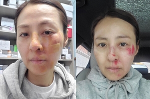 "얼굴 콘크리트에 떨어져"…전혜진, 사고로 피+진물 범벅된 얼굴 공개