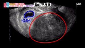 "왜 진작 관리 안 했을까"…산부인과 찾은 이은형, 임신 후 커진 11cm 자궁근종에 죄책감